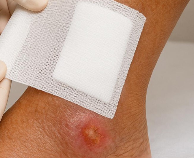 Prevenir las úlceras por presión: la formación marca la diferencia